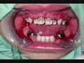 Anterior Venear Stainless Steel Crown Anterior Venear Stainless Steel Crown
