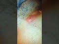 Long John blackhead 3
