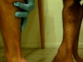 Popping a Cyst .. part 2(even better)