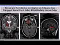 2007 Brain MRI: Moved Brain, Torn Cortex and Spinal Cord