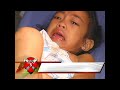 Rescue 5: Tinamaan ng Malas (Firecracker Injury) Rescue 5: Tinamaan ng Malas (Firecracker Injury)