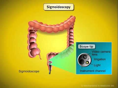 Colo Rectal - Developed and produced by http://www.MechanismsinMedicine.com Animation description: Screening programs aim to identify individuals with cancers at an earlie...