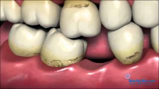 Patient Consent Implant Teeth