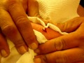 Gross Zit Popping #4