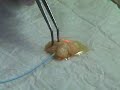 AdvancedAesthetics_Laserlipolisis_Videosample
