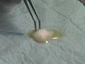 AdvancedAesthetics_Laserlipolisis_Videosample