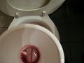 Kidney stone pee Kidney stone pee