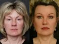 New Jersey Rhinoplasty New Jersey Rhinoplasty