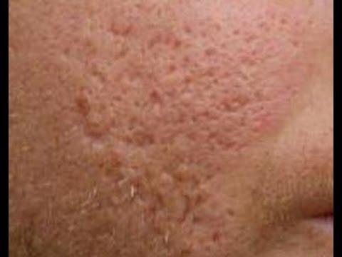 how to repair acne damaged skin