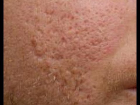 how to cure old scars