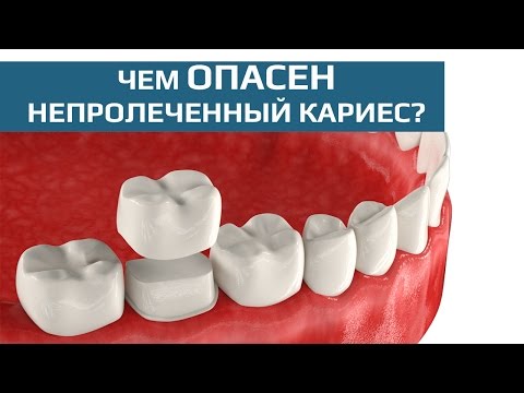 Восстановление жевательного зуба коронкой