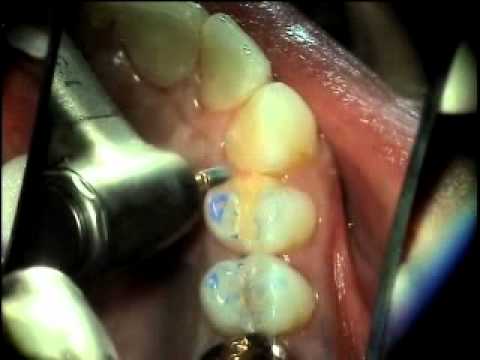 Gordon discusses occlusal equilibration concepts, and shows live clinical techniques