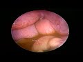 Diagnostic Laparoscopy