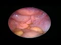 Diagnostic Laparoscopy Diagnostic Laparoscopy