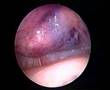 Diagnostic Laparoscopy