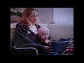 Aging Young (Progeria)  Part 1