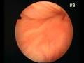 hysteroscopic aspect of adenomyosis