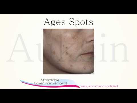 how to get rid of brown age spots