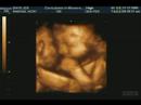 Baby Raskas at 29.5 weeks