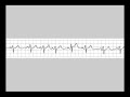 CORSO MULTIMEDIALE DI ECG