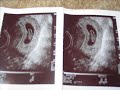 First Pregnancy / First Baby