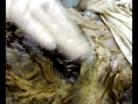 Abdominal Peritoneum