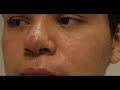 The Acne Practice (severe case 4) The Acne Practice (severe case 4)
