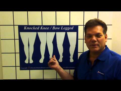 how to cure knock knees