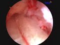 ACL Knee Surgery