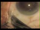 anestesia subtenoniana 