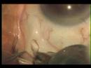 anestesia subtenoniana 