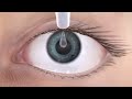 Dry Eye: AllThingsEyes Dry eye, what causes it