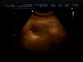 Ana Júlia - Ultrassom (5 meses)