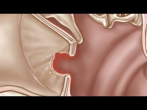 how to drain ruptured eardrum