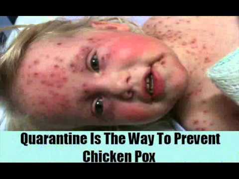 how to avoid chicken pox
