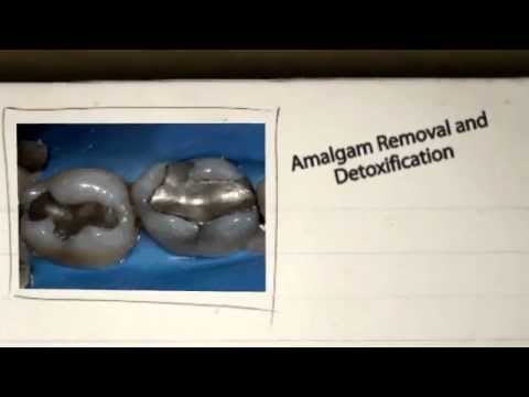 Amalgam Removal – St Leonards Holistic Dental Care in Sydney – Removing Mercury Amalgam Fillngs