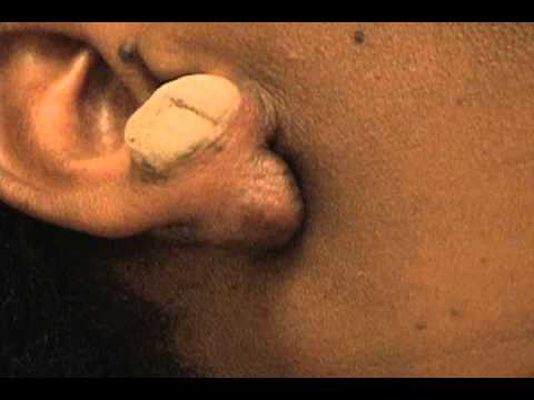 how to whiten keloid