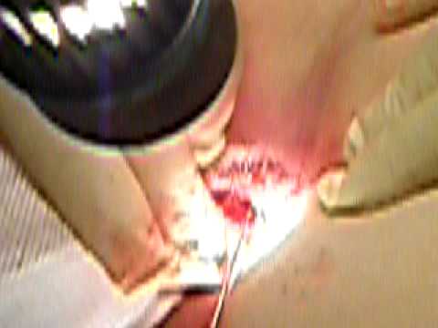 PERIANAL ABSCESS - Doctor trying to drain an abscess. I was having SEVERE pain in my guts but was on antibiotics at the time-- my fever stayed pretty low despite feeling horrib...
