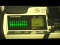 Supraventricular Tachycardia