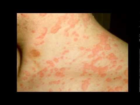 how to relieve urticaria