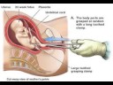 how to repair uterine rupture