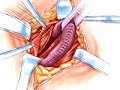 PreOp® Patient Education: Hernia Repair Inguinal Surgery 2