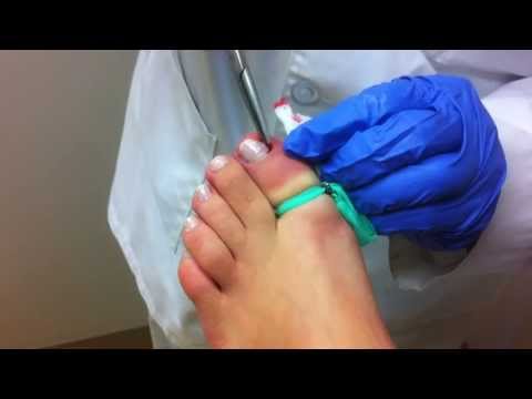 how to drain pus from toe
