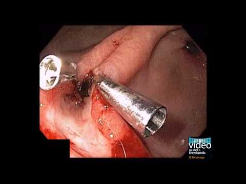 how to perform upper gi endoscopy