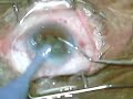 Ozile Hard Cataract