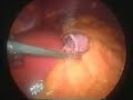 Gastrik by-pass
