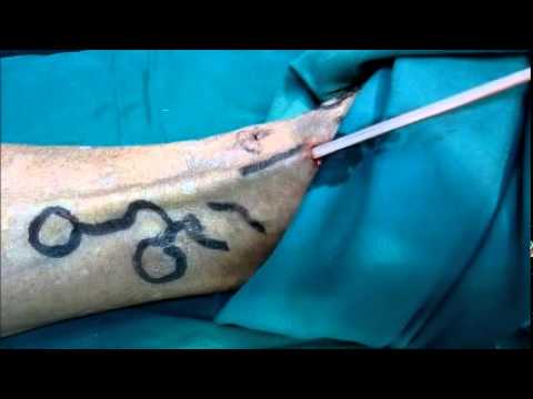 safenectomia -