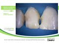 Ceram X duo: Restauraci�n de anteriores Dr. Dietschi