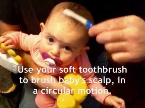 how to cure cradle cap