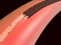 CryoSpray Ablation - High Grade Dysplasia CryoSpray Ablation - High Grade Dysplasia